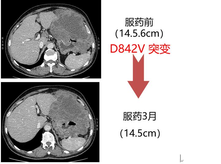 基因检测靶向治疗真的有效果吗,长沙医院癌症靶向治疗基因检测