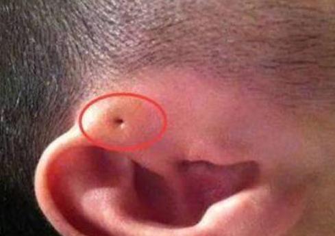 孩子耳朵里长了肉球,耳朵旁边有个小肉球几岁可以切除