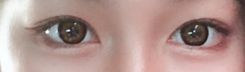 肿眼泡抽脂肪埋线双眼皮效果,肿眼泡割双眼皮长脂肪