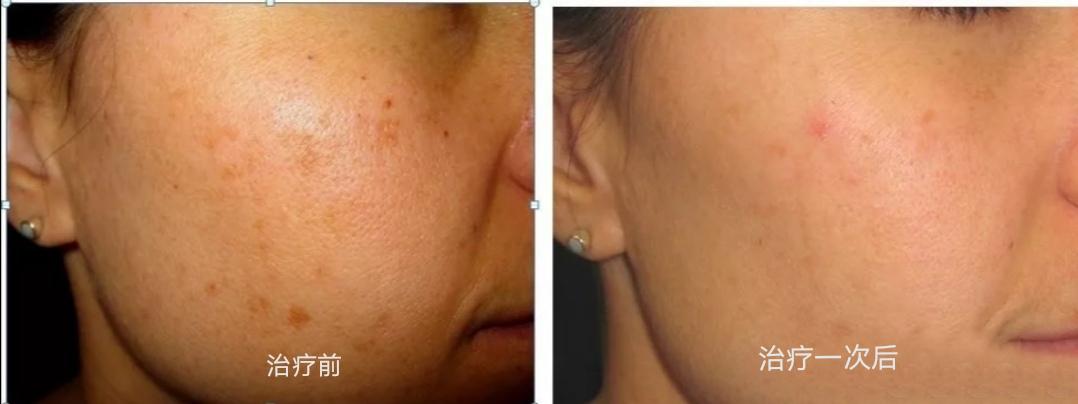 光子嫩肤的基本方法,光子嫩肤如何达到嫩肤效果