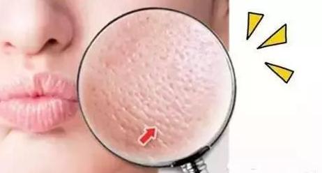 油光型毛孔粗大护肤步骤,收缩毛孔粗大的方法干皮敏感肌