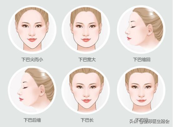 面中部凹陷下巴微翘,朱元璋式下巴怎么矫正