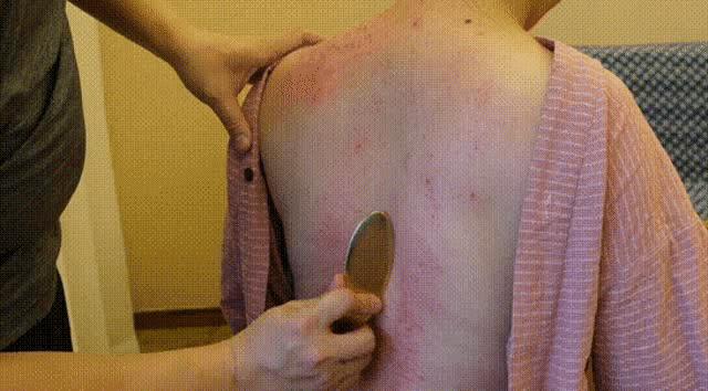 刮痧祛三焦湿热,刮痧头部两侧胆经