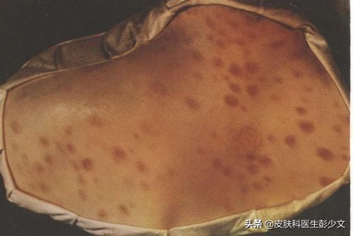 连续十年不停的长痘疮是怎么回事,身上长痘疮怎么治疗