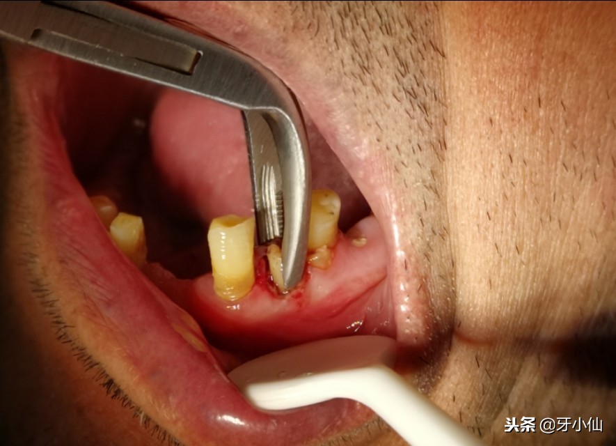 拔牙到底疼不疼几分钟能搞定,拔牙后很疼是伤到牙神经了吗