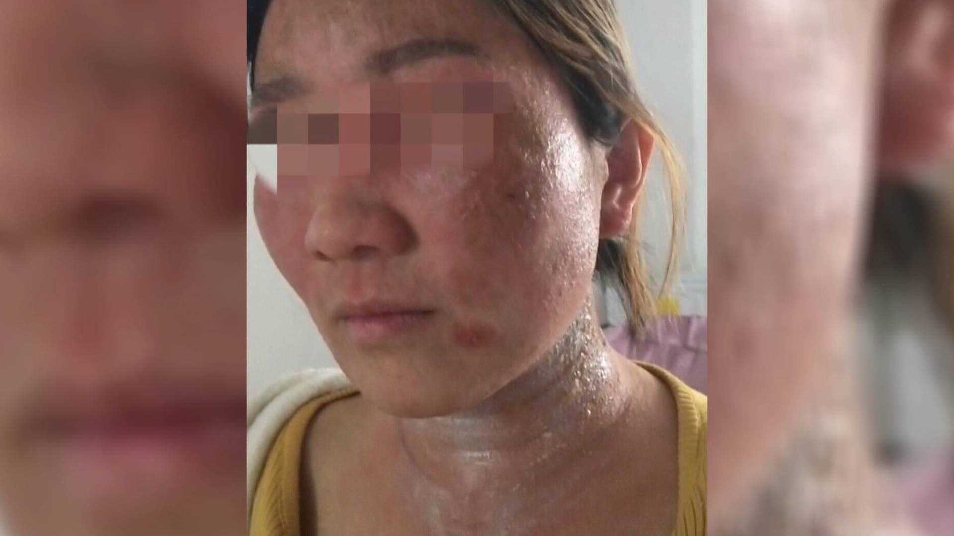 去美容院美容变毁容,女子面部毁容整容医生看不下去