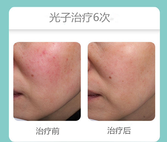 敏感性皮肤怎么修复角质层,过敏性皮肤怎样修复皮肤屏障