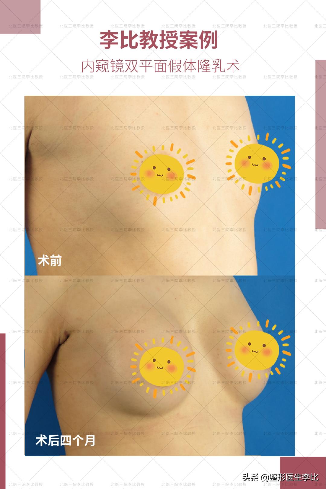 我有一对不会长大的胸，怎么办？（含案例）