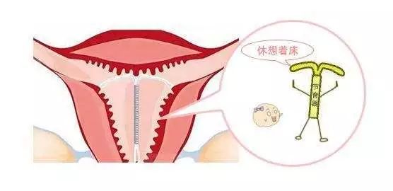 20岁女孩第四次人流,二十一岁女孩人流五次