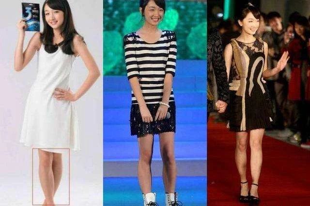 小腿肌肉外翻和膝盖内扣一样吗,小腿肌肉外翻骨头是弯的