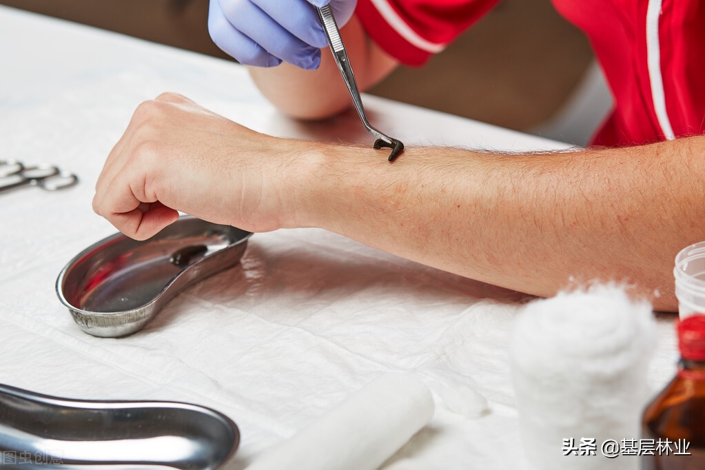 山蚂蝗被咬血止不住,山蚂蝗咬后痒怎么办