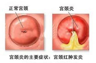 宫颈糜烂严重吗有必要做手术吗,宫颈糜烂需不需要治