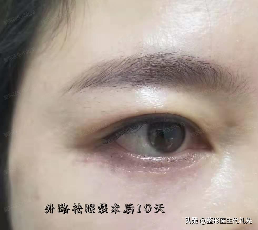 祛眼袋眼睑轻度外翻悬吊多久能好,外切口去眼袋面部提升能维持多久