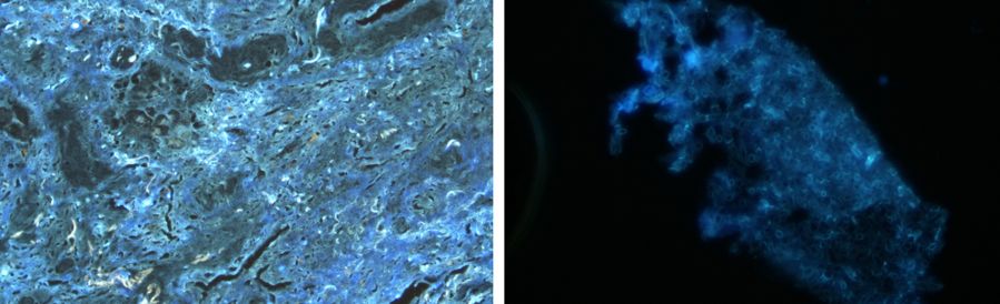 如何发现肺部真菌感染,怎样早期识别真菌感染