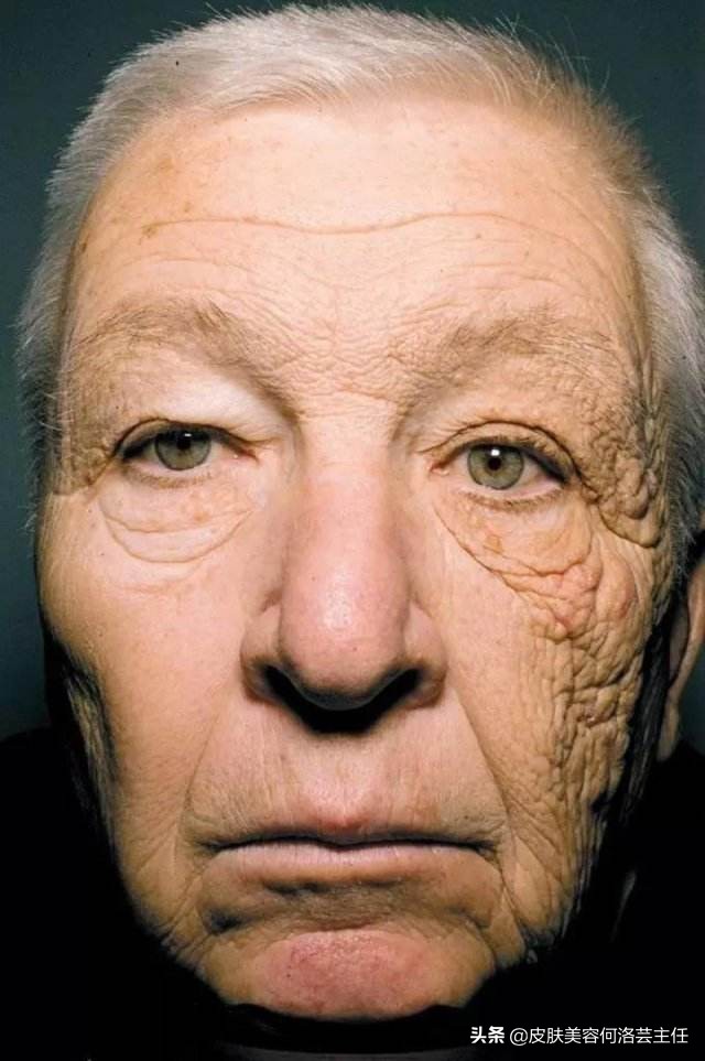 脸上有皱纹的朋友教你一个小诀窍,脸上有皱纹的原因和治疗方法