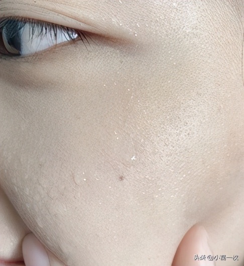 青春期祛痘的弯路,怎么做到真正祛痘