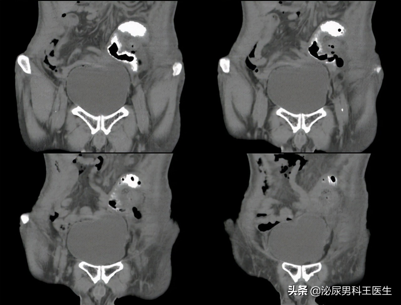 一个人没有直肠怎么办,一个人没有大肠怎么生活