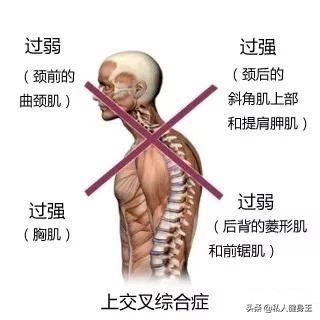 你有什么方法能改善驼背,如果你有驼背现象该怎么办