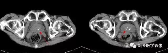 腹部平片可以看出肠胃疾病吗,腹部散在结节状高密度影