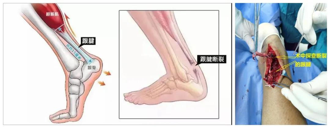 阿喀琉斯跟腱断裂原因,跟腱拉着疼痛是怎么了