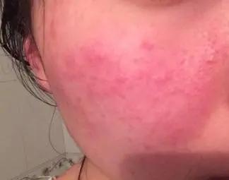 有多少人因为刷酸而烂脸,刷酸到底是换脸还是烂脸