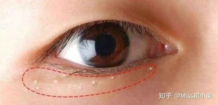 拯救你的卡路里电影,眼部脂肪粒怎么拯救