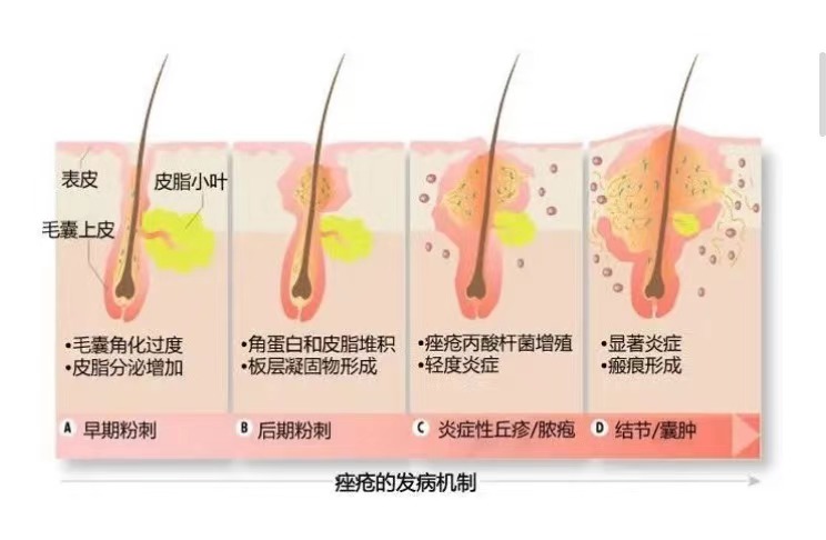 男士祛痘用什么护肤品比较好,男士祛痘护肤品官方旗舰店直播