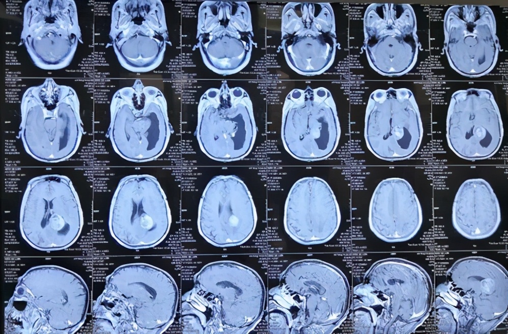 化脓性汗腺炎是什么引起的,化脓性汗腺炎是怎么引起的