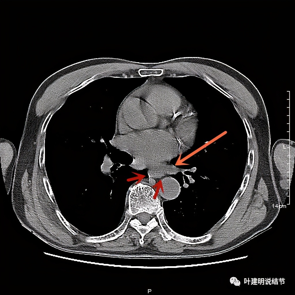 同时发现结肠癌和肺癌怎么处理,同时患结肠癌和直肠癌怎么办