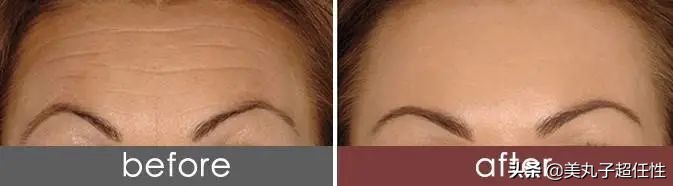 再也不用发愁抬头纹,很深的抬头纹怎么可以完全消失