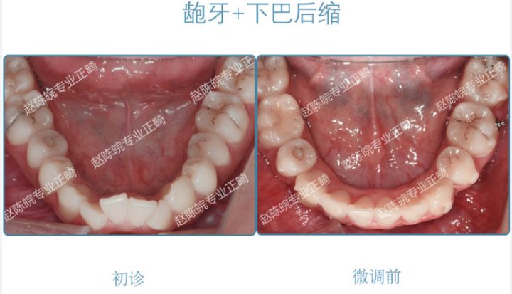 杭州成人隐形矫正牙齿优惠,矫正牙齿杭州无创伤
