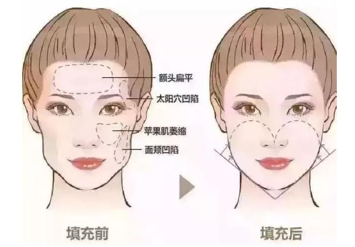 光子嫩肤脱毛仪的危害和禁忌,光子嫩肤注意事项文字