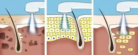 激光美容时遇到睑缘肿物，用激光和手术切除有啥区别？