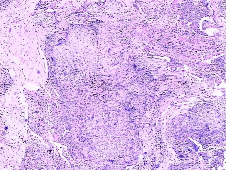 养鸽子造成皮肤真菌感染,养鸽子会得肺炎吗