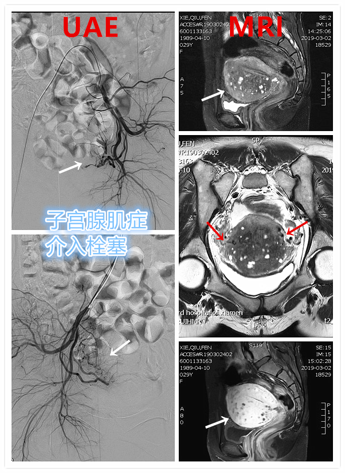 子宫腺肌症「不死的癌症」——介入栓塞来帮忙