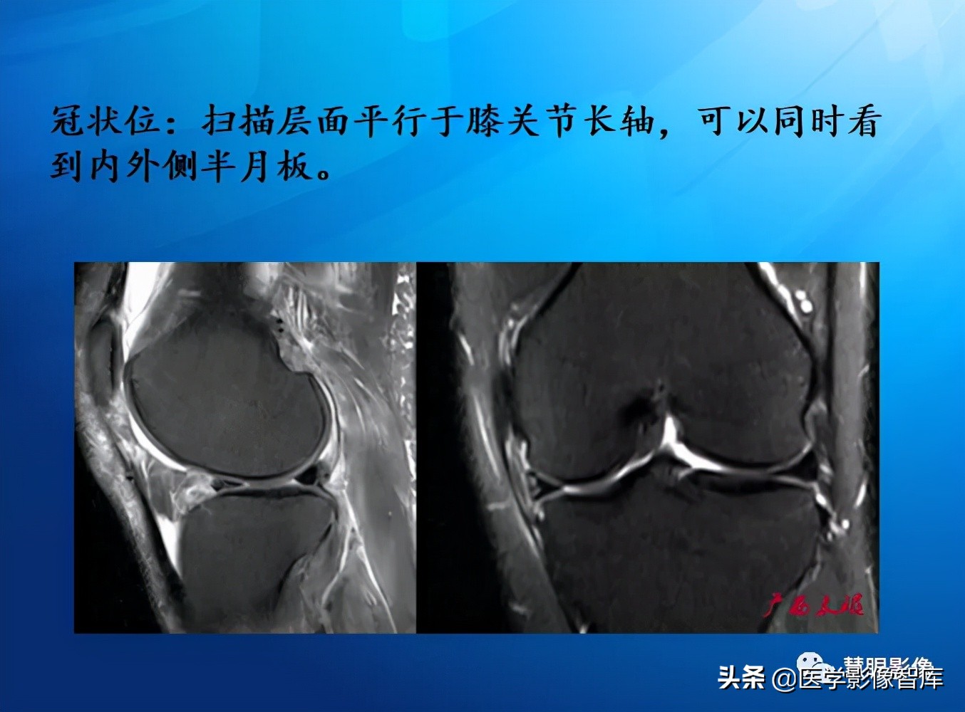 膝关节半月板损伤的解剖结构图,半月板mri解剖图解