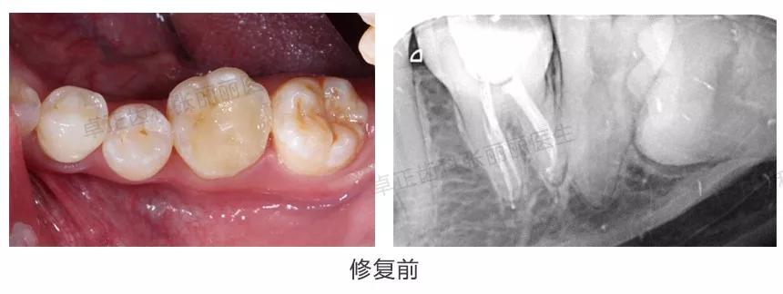 牙齿楔状缺损修复图片,牙齿楔状缺损修复大概多少钱