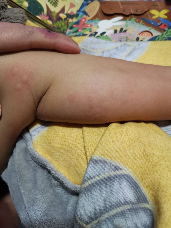 宝宝身上起疙瘩像蚊子咬一样还痒,宝宝身上长疙瘩像蚊虫叮咬怎么办
