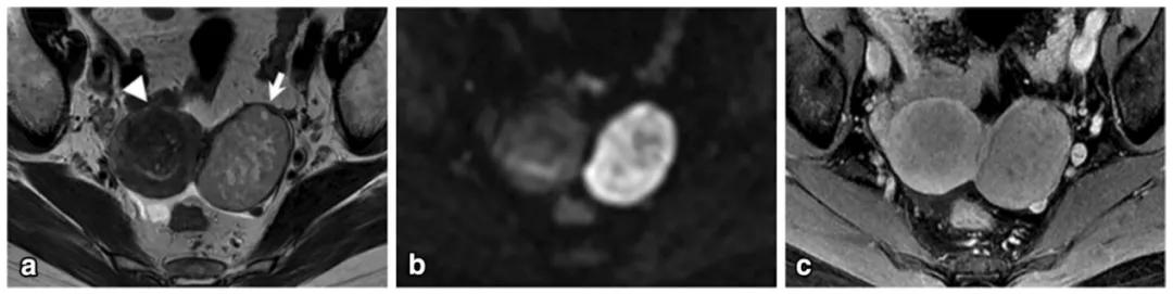 卵巢实性为主肿瘤，这13种你都想到了吗？