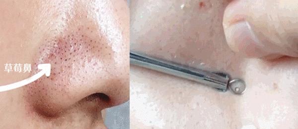 长黑头VS不长黑头差距这么大?精致女孩如何绕过黑头这道坎?