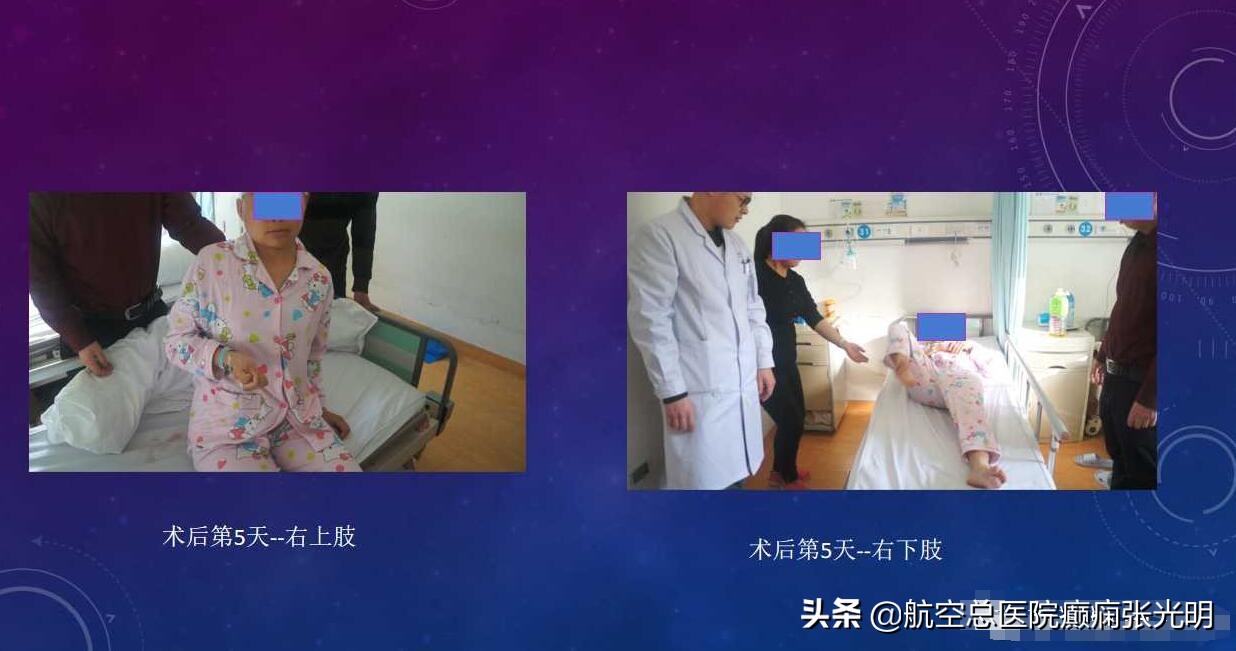 张光明左颞叶癫痫手术成功率,张光明谈治疗癫痫的方法有哪些