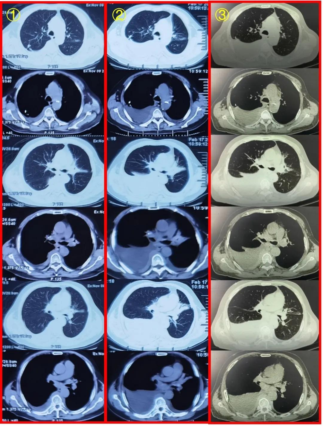 咳嗽咳痰胸腔积液10月余治疗无效，艰难追踪得出哪些教训？（上）