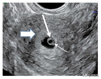一分钟看懂孕期b超图,孕期32周照b超宝宝头大怎么办