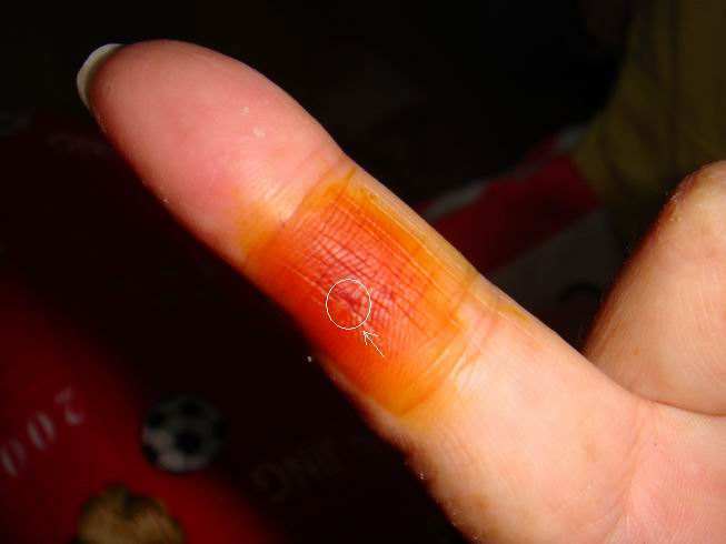 木刺扎到手指急救妙招,不小心把刺戳进手指里怎么办