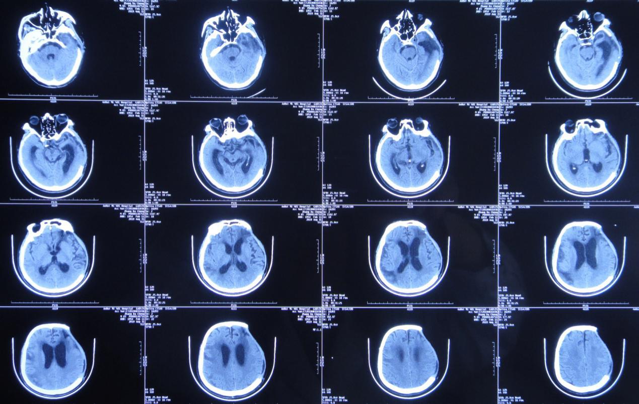 颅脑外伤术后脑积水,脑外伤脑积水颅骨缺失