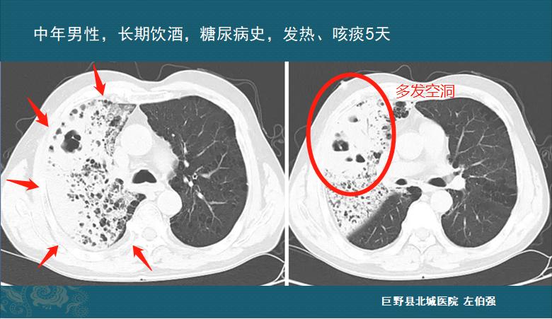 肺炎感染者吐痰,肺炎患者咳大量黄痰最有可能感染