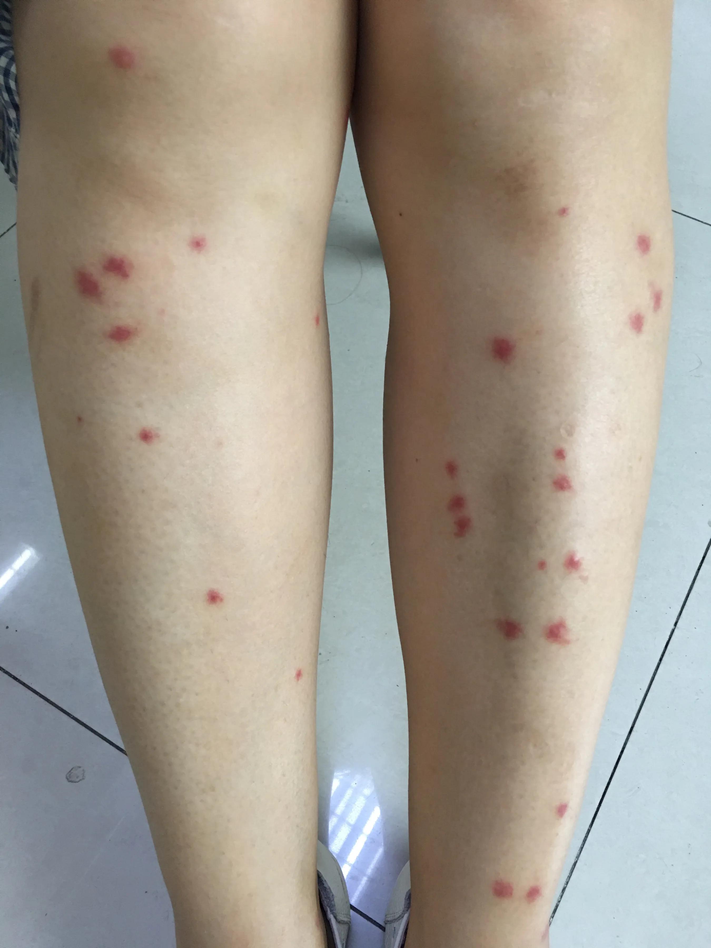 轻松应对夏季常见皮肤病（二）——虫咬皮炎！