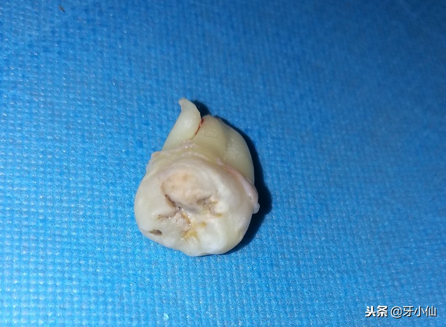 拔牙到底疼不疼几分钟能搞定,拔牙后很疼是伤到牙神经了吗