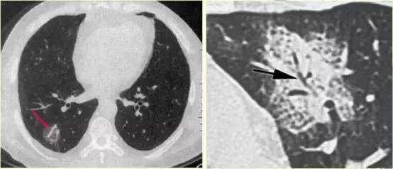 肺部ct十大征象,肺部ct正常图和异常图的区别