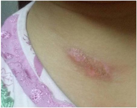 补骨脂治疗白癜风会好吗,补骨脂针剂治疗白癜风是天天打吗